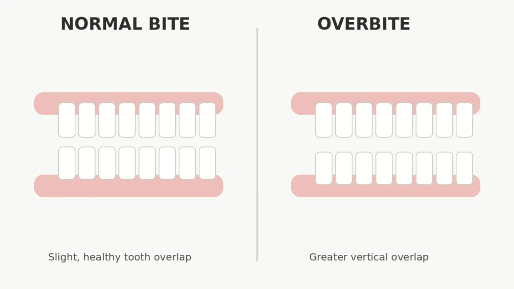 Overbite vs Normal