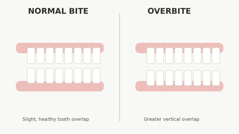 Overbite vs Normal